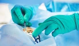 Mengenal Perbedaan LASIK dengan Metode Koreksi Penglihatan Lainnya
