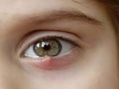 Mata Bintitan, Kapan Bisa Sembuh Sendiri dan Kapan Harus ke Dokter?